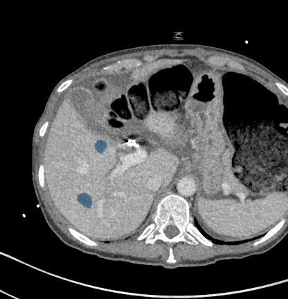 LIXccrDJ5ADyoANq - TotalSegmentator - Liver Lesions (CT) case preview