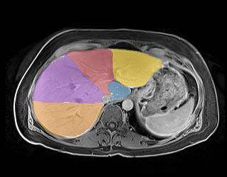TotalSegmentator - Liver Couinaud Segments (MR) preview