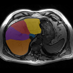 1oqsYgz8VneMqTBF - TotalSegmentator - Liver Couinaud Segments (MR) case preview
