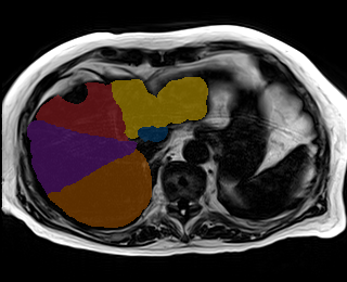 3kz5yIBfcwwl7sLm - TotalSegmentator - Liver Couinaud Segments (MR) case preview