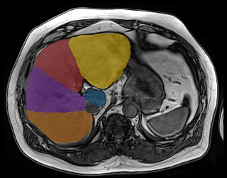 4fBAadbkrWlohMl5 - TotalSegmentator - Liver Couinaud Segments (MR) case preview