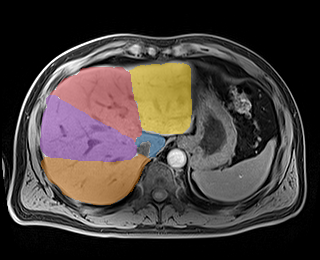 YIMSjo3ZL9jfEIsC - TotalSegmentator - Liver Couinaud Segments (MR) case preview