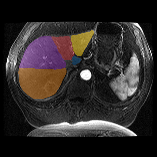 kbdGS2laG0N4H0q6 - TotalSegmentator - Liver Couinaud Segments (MR) case preview