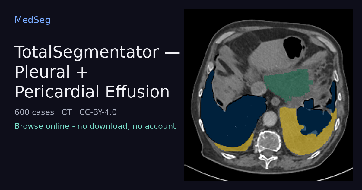 TotalSegmentator - Pleural + Pericardial Effusion - example case rendered in the MedSeg editor