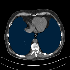 1h2xATs36nxUasO2 - TotalSegmentator - Pleural + Pericardial Effusion case preview