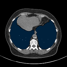 2xZ96zMt15HjjMa8 - TotalSegmentator - Pleural + Pericardial Effusion case preview