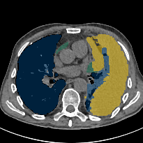 DR7tr9tvUhzo8Kdc - TotalSegmentator - Pleural + Pericardial Effusion case preview