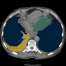 YBrOGKr3ULGygQPU - TotalSegmentator - Pleural + Pericardial Effusion case preview