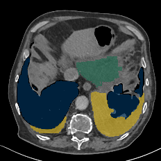TotalSegmentator - Pleural + Pericardial Effusion preview