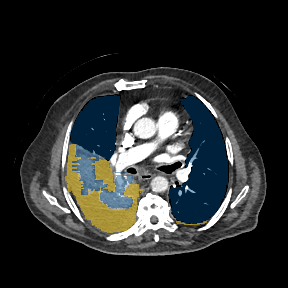 zi4G2A8BzlQdIjRW - TotalSegmentator - Pleural + Pericardial Effusion case preview