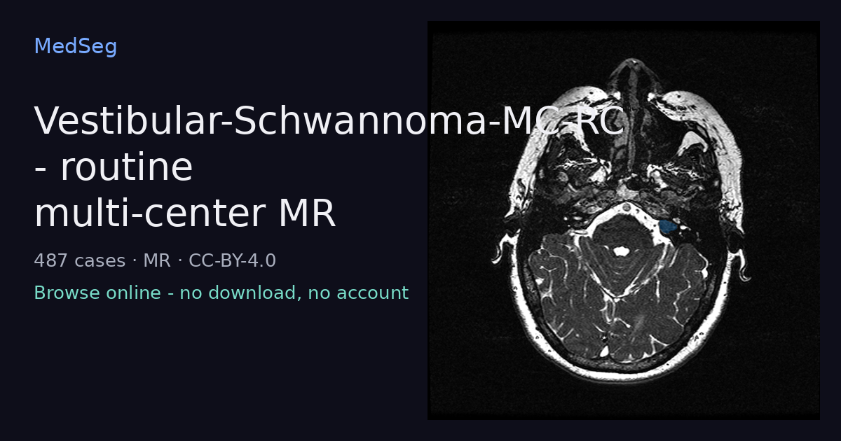 Vestibular-Schwannoma-MC-RC - routine multi-center MR - example case rendered in the MedSeg editor