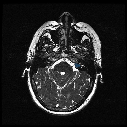 Vestibular-Schwannoma-MC-RC - routine multi-center MR preview