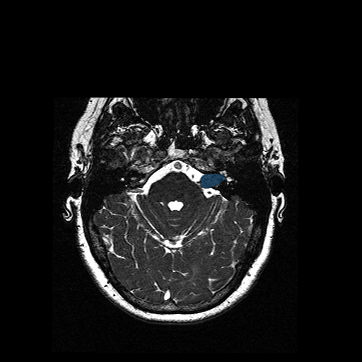 VS-MC-RC-002__1988-10-29__s3__t2-ax-3d-fiesta - Vestibular-Schwannoma-MC-RC - routine multi-center MR case preview