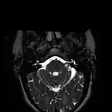 VS-MC-RC-004__1996-11-05__s5__t2-t2-spc-tra-iso - Vestibular-Schwannoma-MC-RC - routine multi-center MR case preview