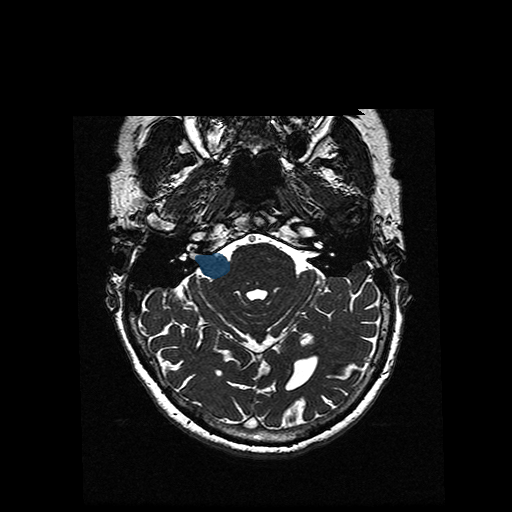 VS-MC-RC-005__1988-09-04__s4__t2-ax-3d-fiesta - Vestibular-Schwannoma-MC-RC - routine multi-center MR case preview