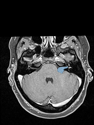 VS-MC-RC-016__1991-09-16__s5__t1-t1-vibe-fs-tra - Vestibular-Schwannoma-MC-RC - routine multi-center MR case preview