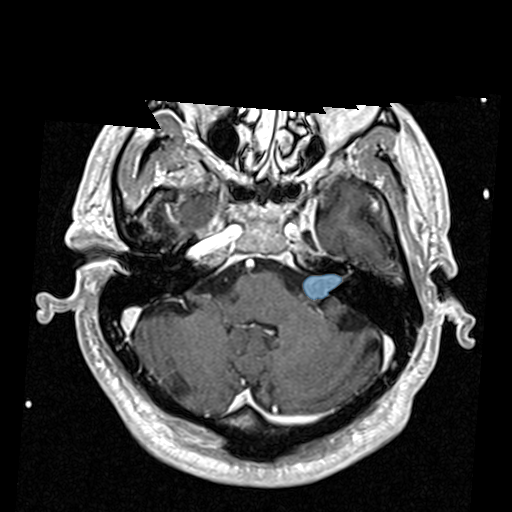 VS-SEG-221__1998-06-23__s2__t1-t1-fl3d-tra-gk-v1 - Vestibular-Schwannoma-MC-RC - routine multi-center MR case preview